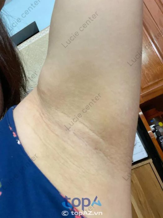 Dịch vụ điều trị thâm nách tại LUCIE được thực hiện với quy trình chuyên nghiệp, giúp bạn sở hữu làn da mịn màng, trắng sáng chỉ sau một liệu trình.