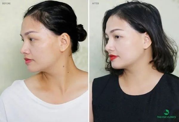 Hình ảnh quy trình điều trị chuẩn y khoa tại Bệnh Viện Thẩm Mỹ Thu Cúc