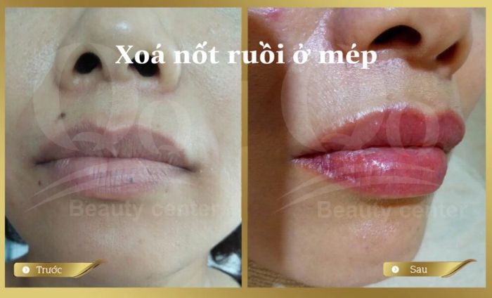 Hình ảnh quy trình điều trị chuẩn y khoa tại Thẩm Mỹ Viện Thanh Quỳnh