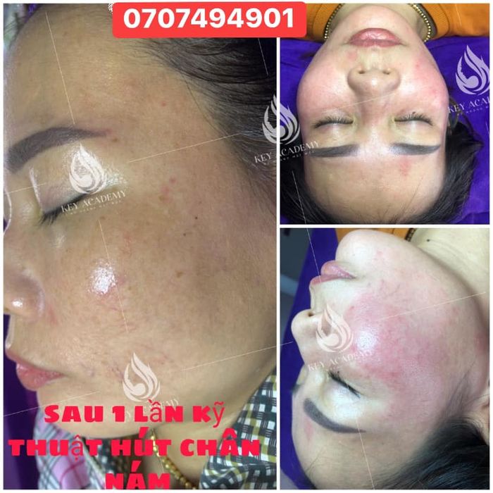 Hình ảnh quy trình điều trị da chuyên nghiệp tại NGẦU BEAUTY & ACADEMY