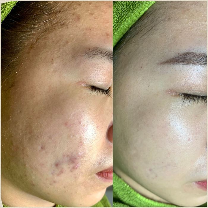 Hình ảnh quy trình điều trị mụn chuyên nghiệp