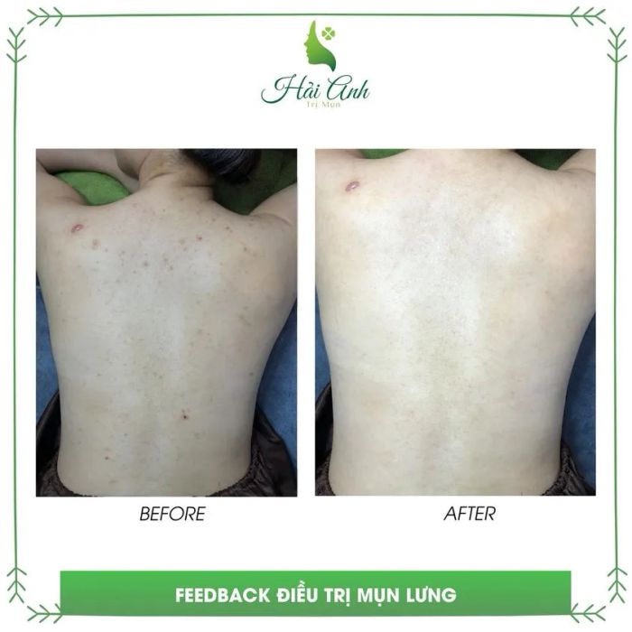 Quy trình trị liệu chuyên nghiệp tại Spa Hải Anh