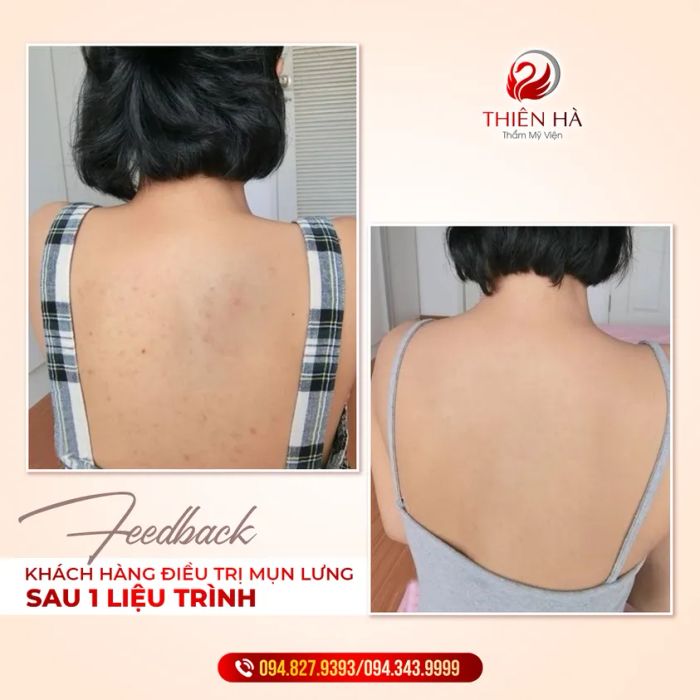 Hình ảnh trị liệu chuyên nghiệp tại Viện Thẩm Mỹ Thiên Hà