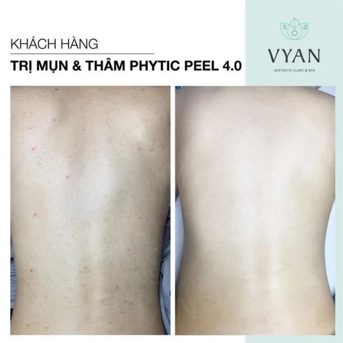 Hình ảnh trị liệu chuyên nghiệp tại Vy An Spa