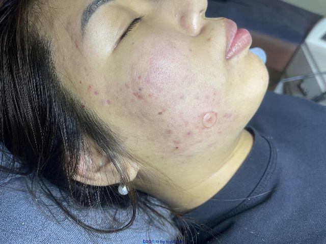 Địa chỉ spa trị mụn và chăm sóc da uy tín bậc nhất tại Tân Uyên, Bình Dương