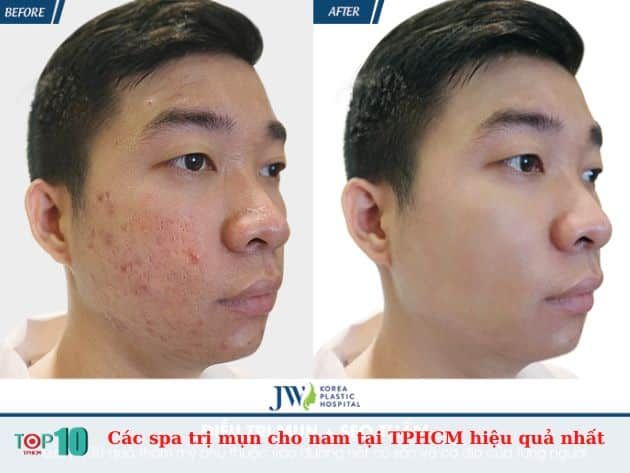 Các spa trị mụn hiệu quả cho nam tại TPHCM