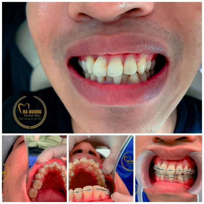 Hình ảnh thực tế tại Nha Khoa Hà Đương