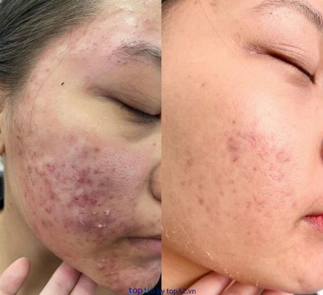 Địa chỉ spa trị mụn và làm đẹp chuẩn y khoa tại Tân Uyên, Bình Dương