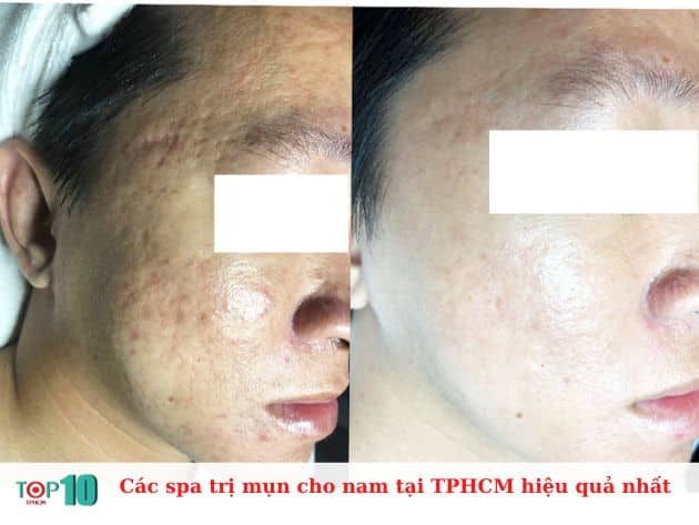 Top các spa trị mụn hiệu quả nhất cho nam tại TPHCM