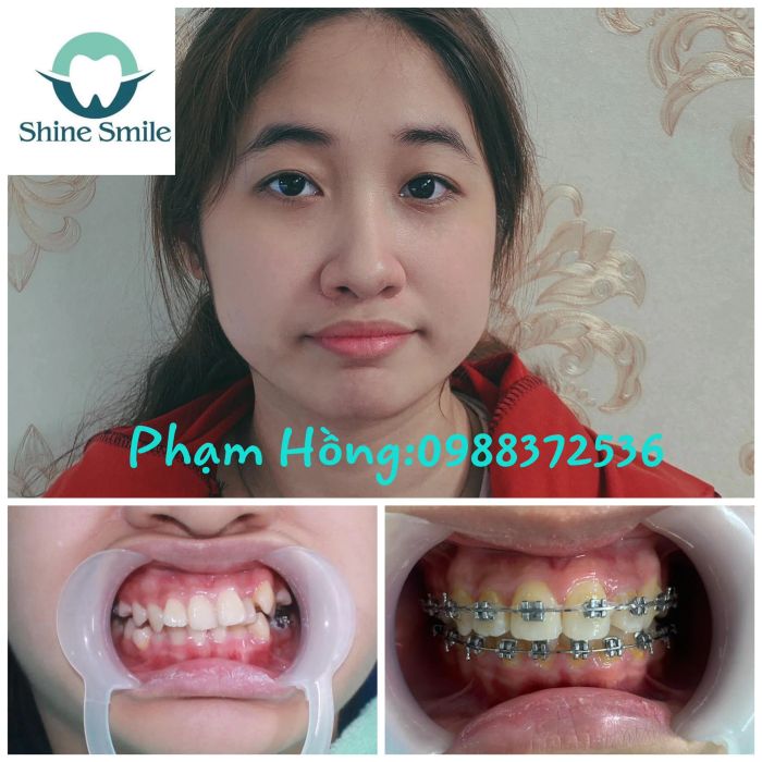 Hình ảnh cơ sở vật chất hiện đại tại Nha Khoa Shine Smile