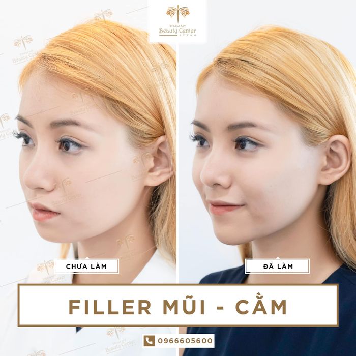 Bộ sưu tập hình ảnh thực tế về quy trình thẩm mỹ chuẩn 5 sao tại Beauty Center By Tấm