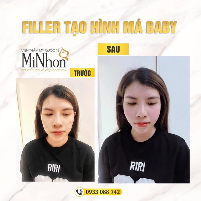 [Album] Bộ sưu tập thành tựu làm đẹp tại Viện Thẩm Mỹ MiNhon