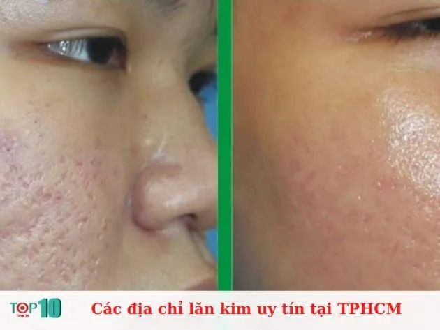 Danh sách địa chỉ lăn kim đáng tin cậy nhất tại TP.HCM