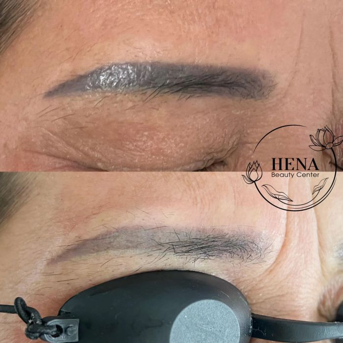 Hình ảnh quy trình xóa xăm chuyên nghiệp tại Hena Beauty Center