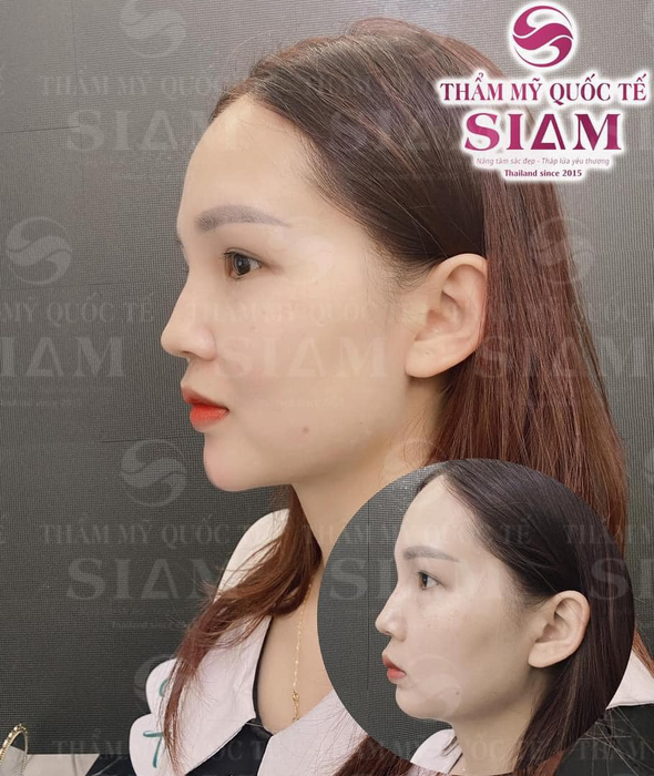 Hình ảnh quy trình tiêm chuẩn y khoa tại Lisiam Hanoi Aesthetic & Training