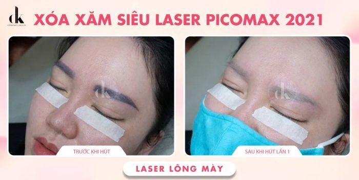 Hình ảnh thực tế về quy trình xóa xăm tại DK Eyebrows & Beauty