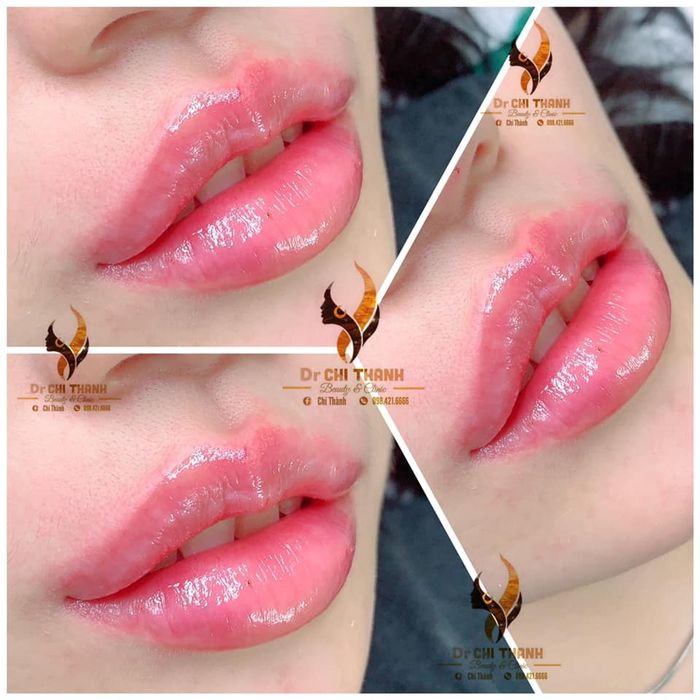 Quy trình tiêm filler chuyên nghiệp tại Dr Chi Thanh Beauty & Clinic