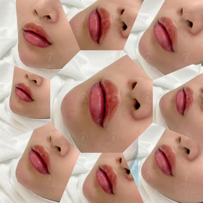 Quy trình tiêm filler chuẩn y khoa tại July Beauty Clinic