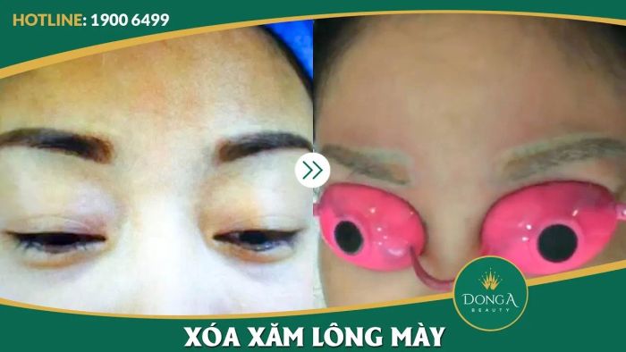 Quy trình xóa xăm bằng công nghệ Ruby Laser tại Đông Á