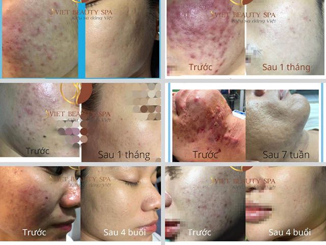 Trị mụn tại SViet Beauty Spa, uy tín và hiệu quả với hình ảnh trước và sau rõ rệt.