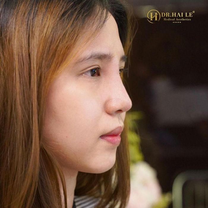Hình ảnh quy trình tiêm chuẩn y khoa tại Viện Thẩm Mỹ Dr.Hải Lê