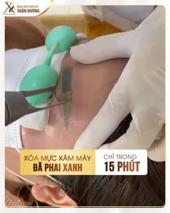 Quy trình xóa xăm bằng công nghệ New Pastelle Laser