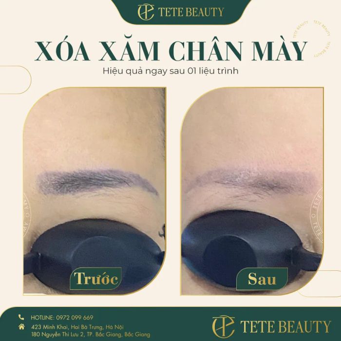 Hình ảnh thực tế quy trình xóa xăm tại Tete Beauty