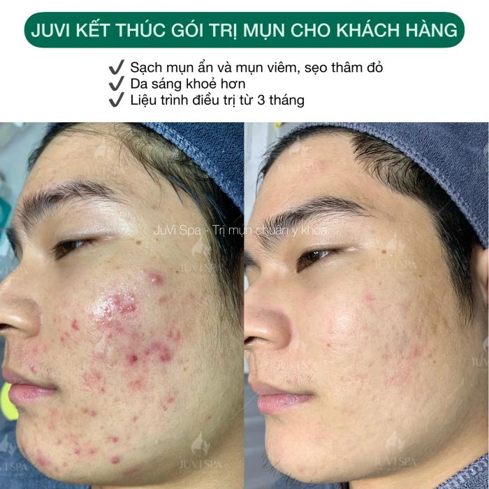 JUVI SPA - Hình ảnh thực tế quy trình trị liệu chuẩn y khoa