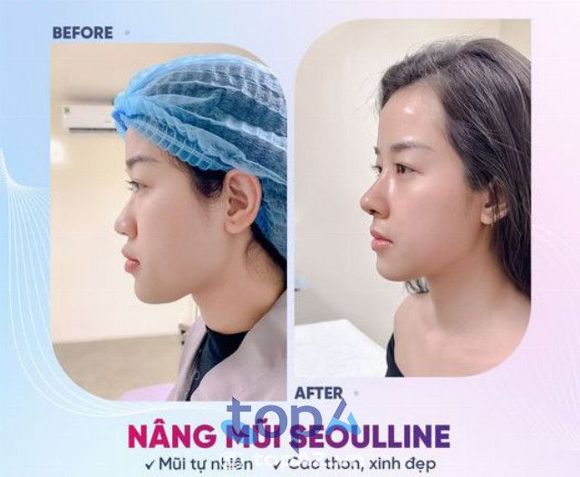 Gợi ý địa chỉ nâng mũi uy tín chuẩn Hàn tại Bạc Liêu