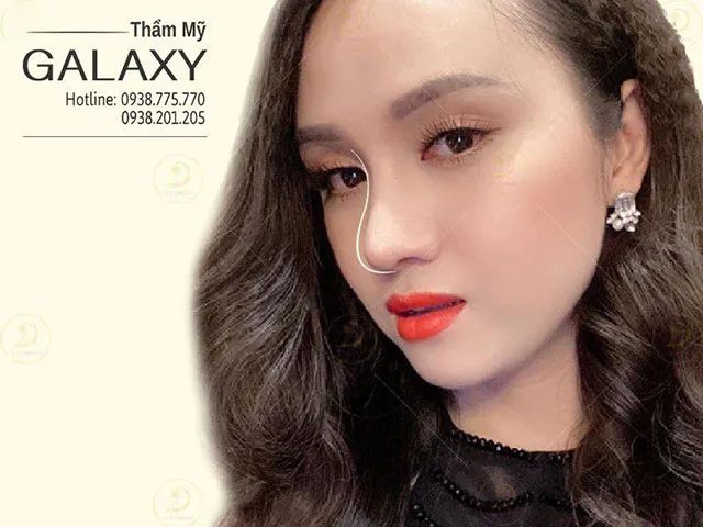 Nâng mũi tại Thẩm mỹ Galaxy cùng bác sĩ Lê Trần Duy – Giải pháp làm đẹp an toàn và hiệu quả