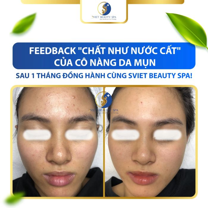 Quy trình trị mụn chuyên nghiệp tại Sviet Beauty Spa
