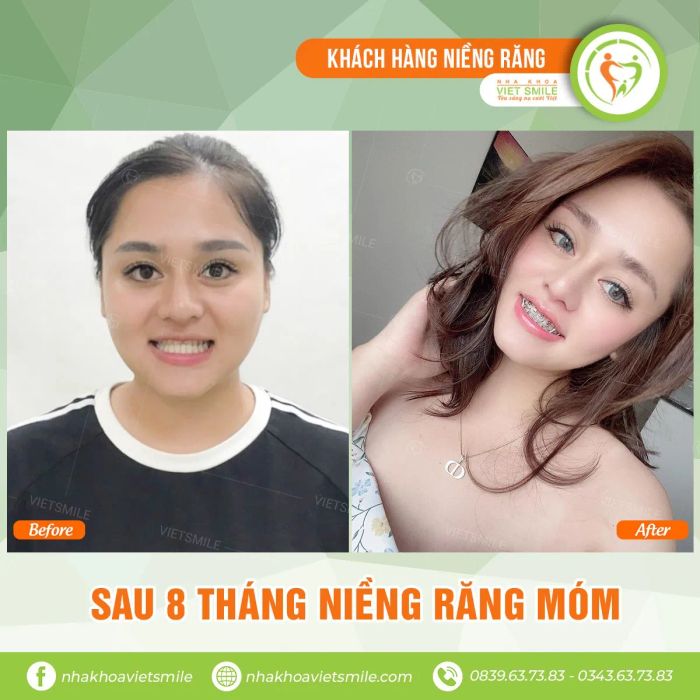 Kết quả niềng răng tại Nha Khoa VIET SMILE