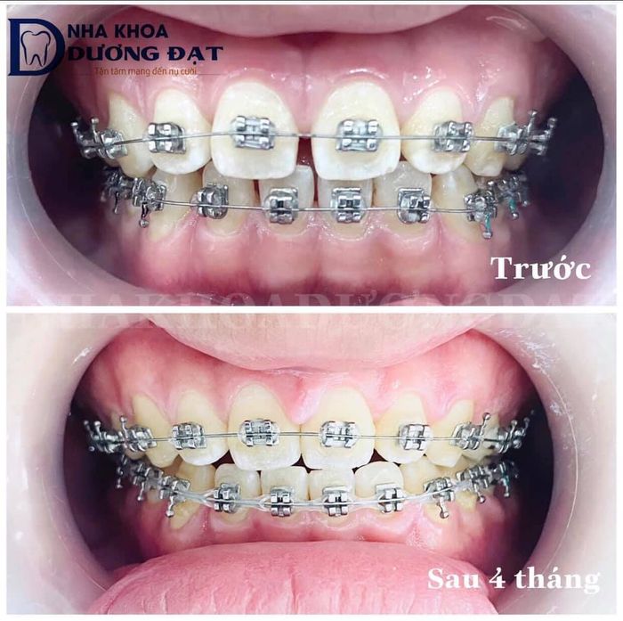 Hình ảnh thành phẩm niềng răng ấn tượng tại Nha khoa Dương Đạt