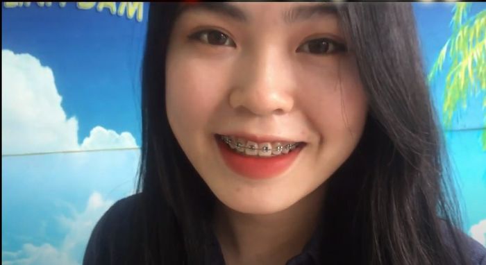 Hình ảnh thành phẩm niềng răng ấn tượng tại Nha Khoa Kiểu Mẫu Linh Đàm