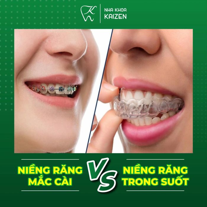 Kết quả niềng răng tại Nha Khoa Kaizen