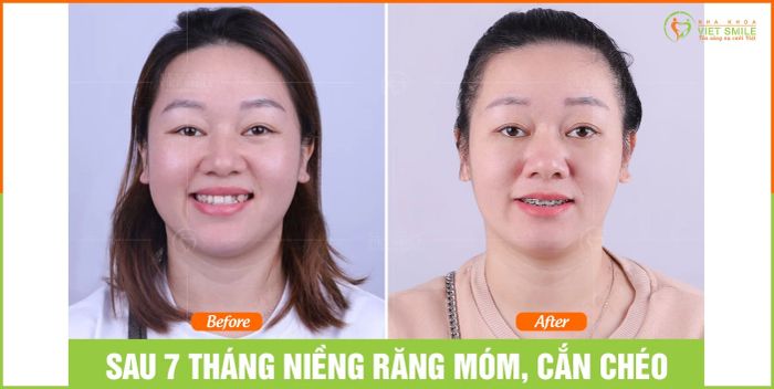 Hình ảnh thực tế tại Nha Khoa VIET SMILE