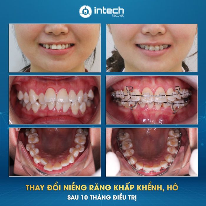 Hình ảnh thực tế về Nha Khoa Lạc Việt Intech