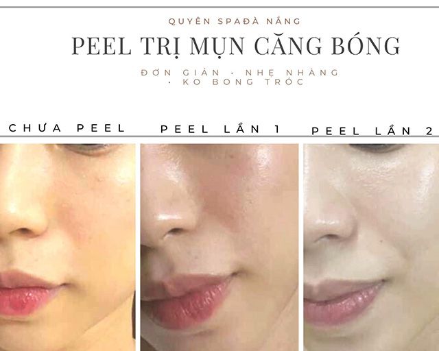 Địa chỉ vàng về chăm sóc da và trị mụn tại Quận Sơn Trà, Đà Nẵng