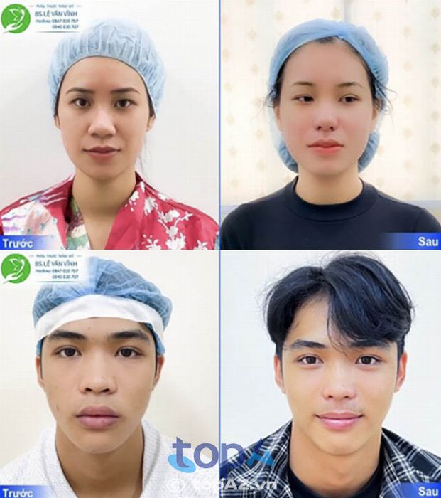 Hình ảnh trước và sau khi thực hiện dịch vụ Thu gọn cánh mũi tại Bác sĩ Lê Văn Vĩnh.