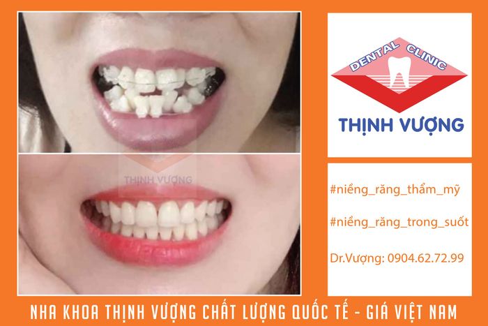 Hình ảnh 2 tại Nha Khoa Thịnh Vượng - Không gian điều trị cao cấp với hệ thống máy móc hiện đại, nơi các bác sĩ thực hiện những ca niềng răng Invisalign chuẩn quốc tế.