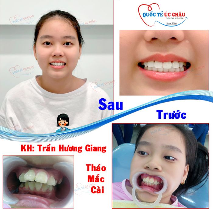 Hình ảnh 2 tại Nha Khoa Quốc Tế Úc Châu - Đội ngũ bác sĩ tay nghề cao đang thực hiện ca niềng răng với hệ thống mắc cài hiện đại, đem lại kết quả tối ưu về cả thẩm mỹ và chức năng.