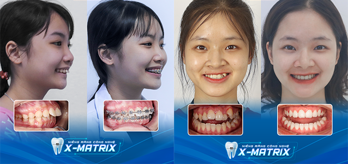 Hình ảnh 1 tại Nha khoa Lạc Việt Intech - Cơ sở vật chất hiện đại với phòng khám tiêu chuẩn quốc tế, nơi ứng dụng thành công công nghệ X-Matrix độc quyền trong chỉnh nha.