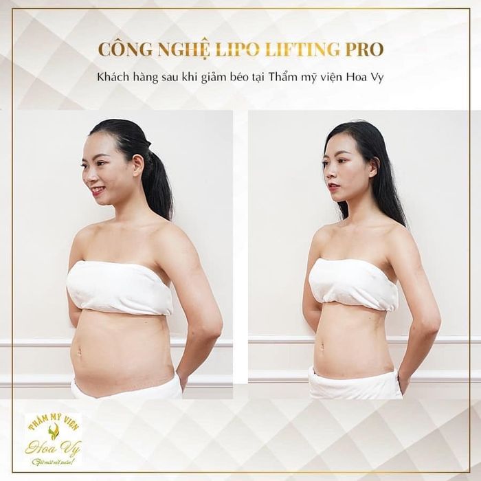 Khu vực điều trị cao cấp với công nghệ Lipo Lifting Pro tại Thẩm Mỹ Viện HoaVy
