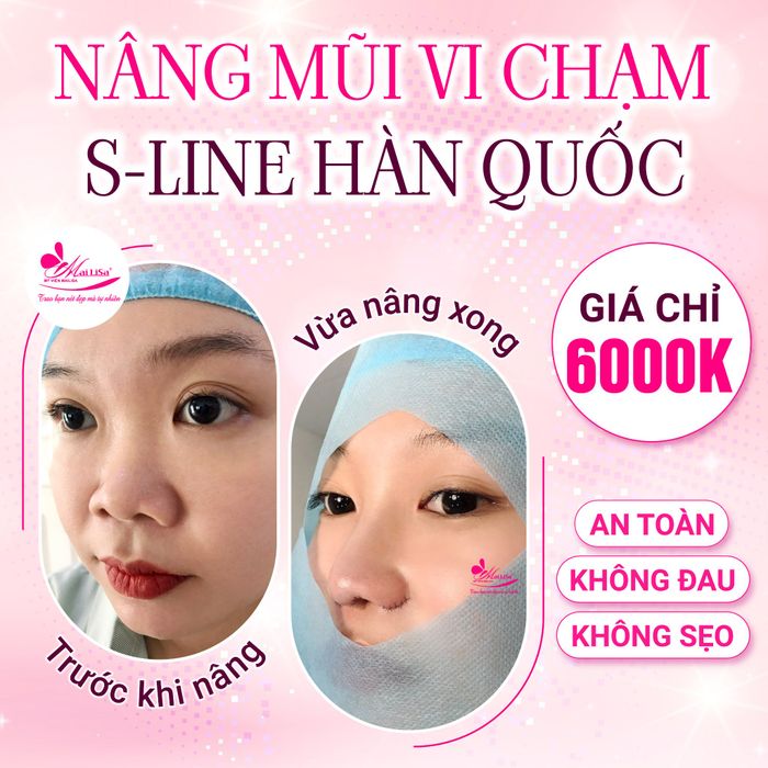 Hình ảnh kết quả nâng mũi tự nhiên tại Thẩm mỹ viện Mailisa