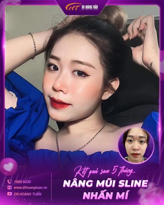 Hình ảnh kết quả nâng mũi tự nhiên tại Dr Hoàng Tuấn