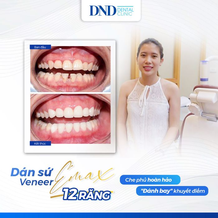 Khám phá vẻ đẹp nụ cười qua hình ảnh thực tế tại Nha Khoa Quốc tế DND – Ảnh số 1