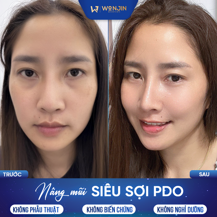 Hình ảnh quy trình nâng mũi công nghệ cao tại Wonjin