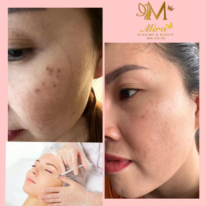 Hình ảnh thứ hai về MIRA SPA - Minh chứng cho quy trình điều trị da chuyên sâu với kết quả trước/sau ấn tượng
