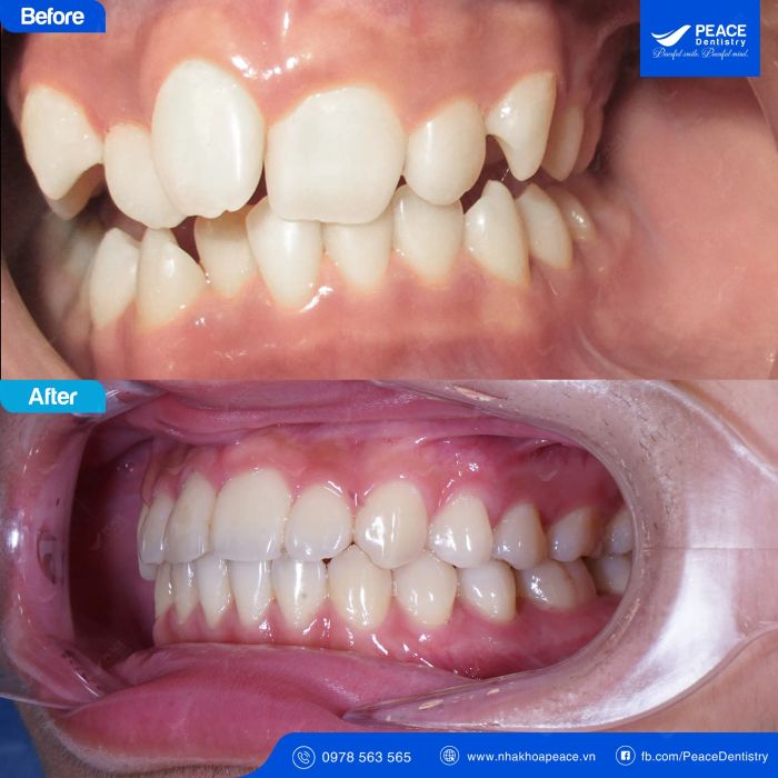 Hình ảnh quy trình niềng răng chuẩn quốc tế tại Peace Dentistry