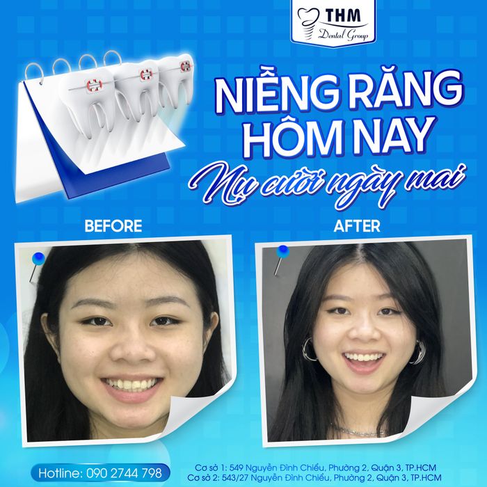 Hình ảnh quy trình niềng răng chuẩn quốc tế tại Nha Khoa Thế Hệ Mới